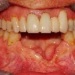 Loss of bone in the anterior mandible after a car accident