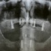 Bone grafts to the maxilla increase bone width and heigh to support implants