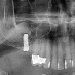 Adecuate amount of bone around dental implant