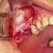 Dental implant in place and bone graft