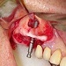 Elevation of the sinus membrane in the site of extracted tooth