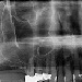 Insuficient bone height in the posterior maxilla with hyperneumatization of the maxillary sinus