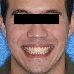 Normal position of upper lip and symmetric smile after maxillary surgery