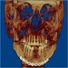 Anterior-posterior 3D CT scan after mandible fracture repair