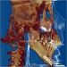 Lateral 3D CT scan after mandible fracture repair