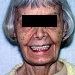 Restored smile and heigh of the lower third of the face with placement of implant supported dentures