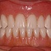 Stable implant supported upper and lower dentures