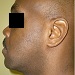 Posterior displacement of left eye due to inferiorly displaced malar bone