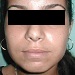 Improve nasal tip width after open rhinoplasty