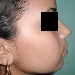 Adequate dorsal and tip projection after open rhinoplasty