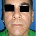 Improvement of doorsal tip width after closed rhinoplasty