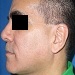 Straight dorsum and tip projection after closed rhinoplasty