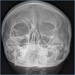 X ray showing multiple titanium plates used for nasal and facial reconstruction