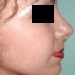 Removed nasal jump and nasal tip surgery to improve projection