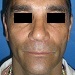 Adequate position of the nose after septorhinoplasty and grafts