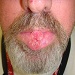 Malignant tumor of the lower lip