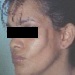 Soft tissue deficiency in the left cheek in a patient with hemifacial atrophy