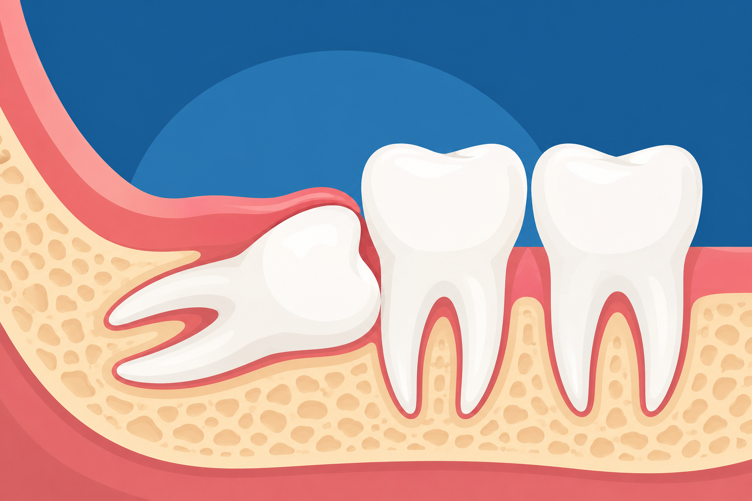 Sideways Wisdom Teeth? What Patients Should Expect