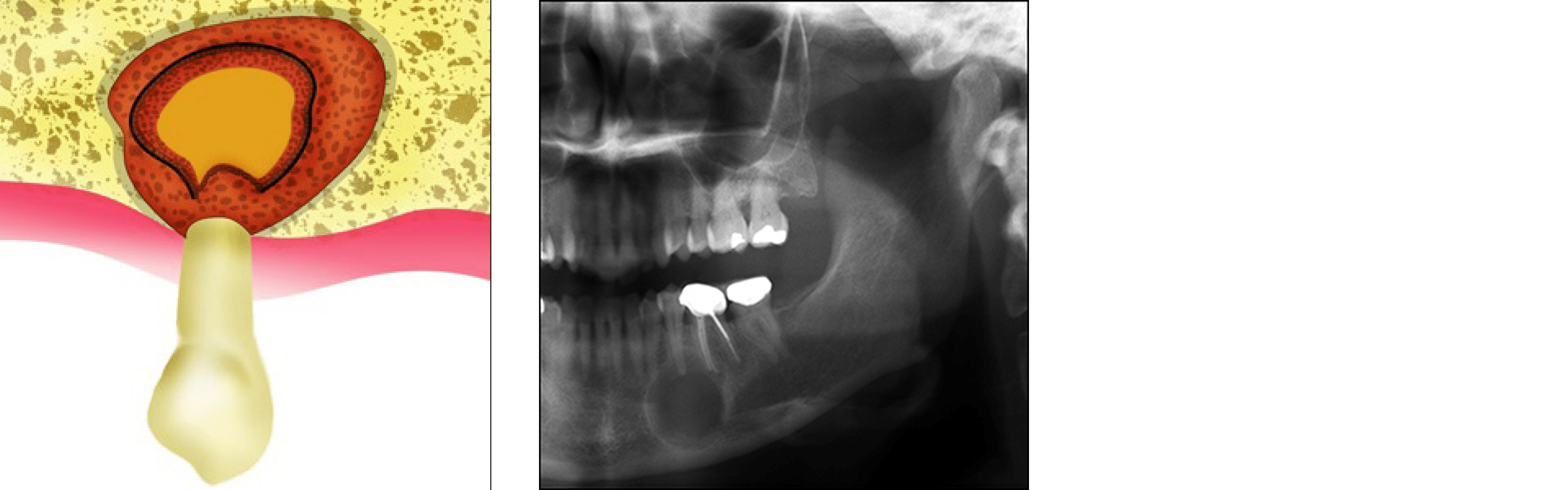 Apicoectomy (Periapical Surgery) Apicoectomy (Periapical Surgery)
