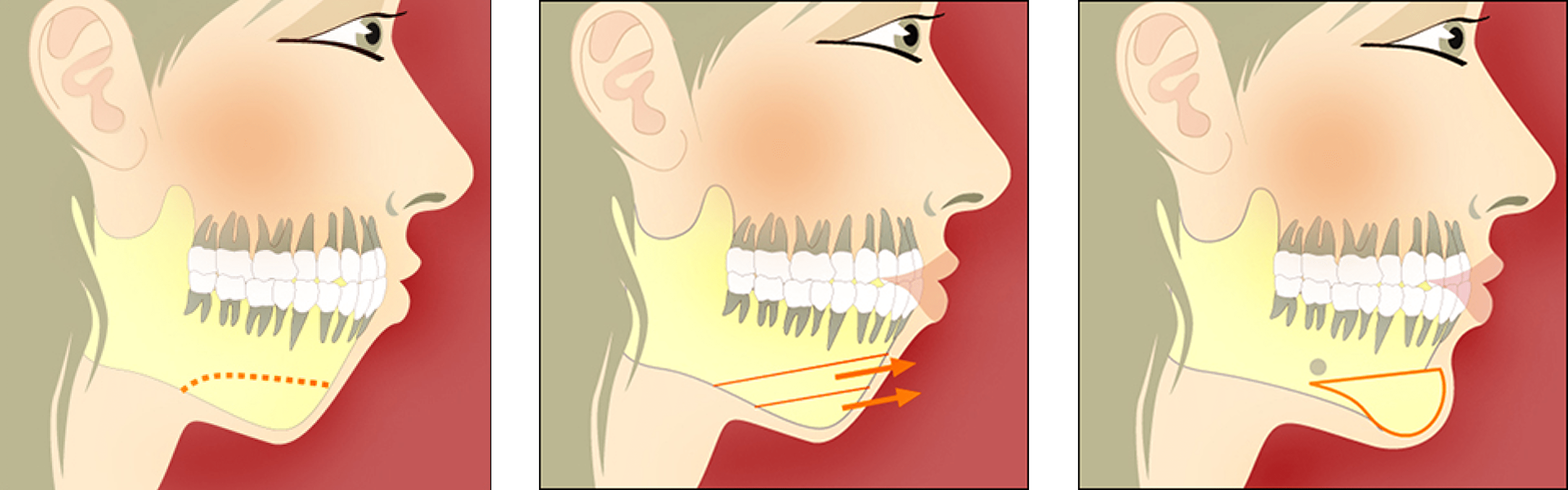 Chin Surgery Chin Surgery