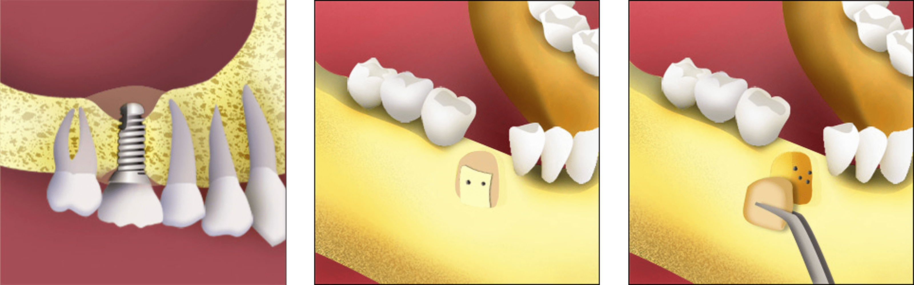 bone-grafting bone-grafting