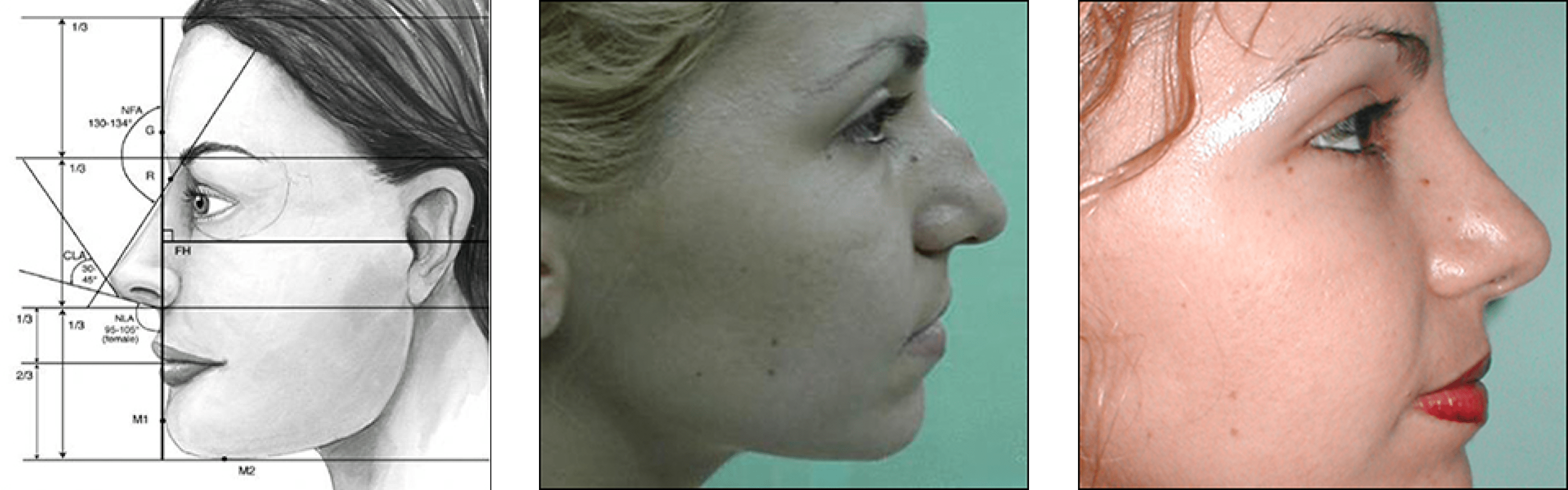 nose surgery rhinoplasty nose surgery rhinoplasty