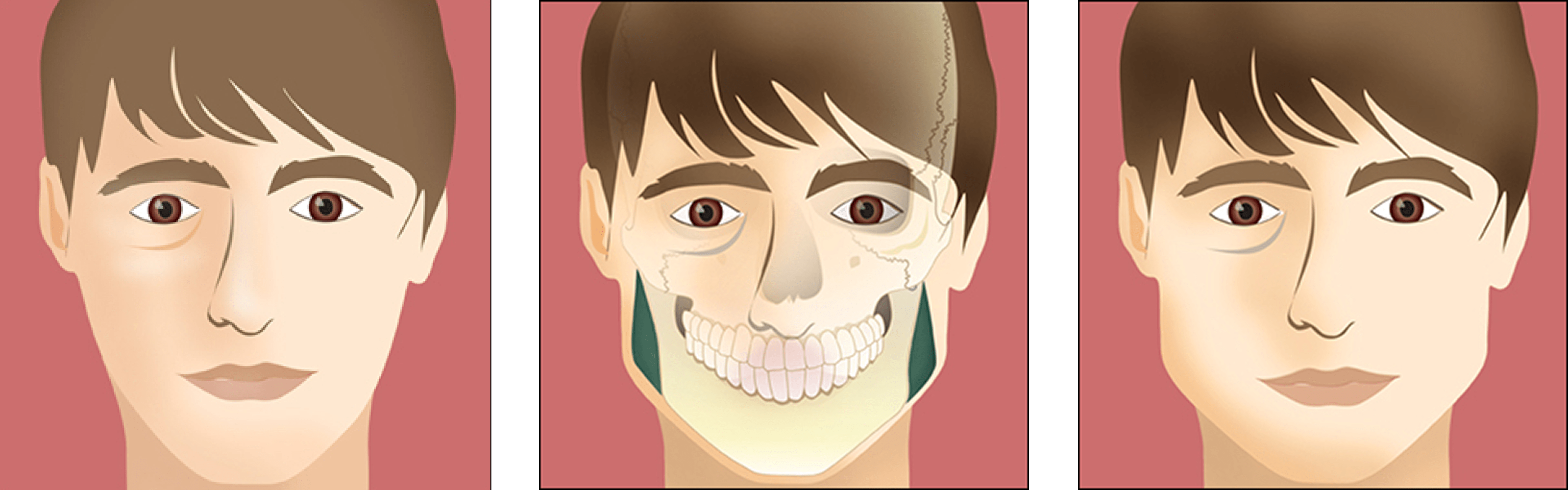Facial Implants cheek chin Facial Implants cheek chin