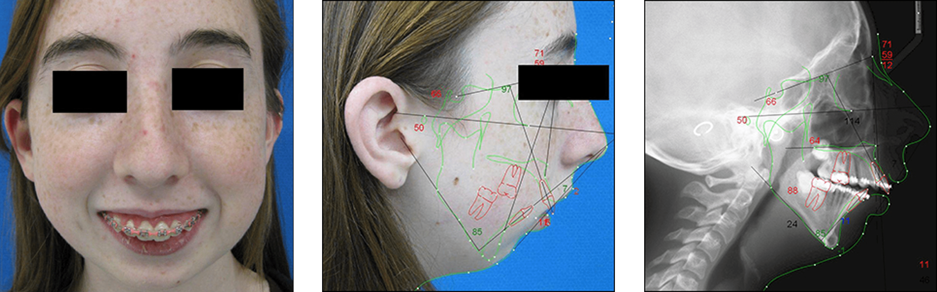 Corrective Jaw Surgery Corrective Jaw Surgery