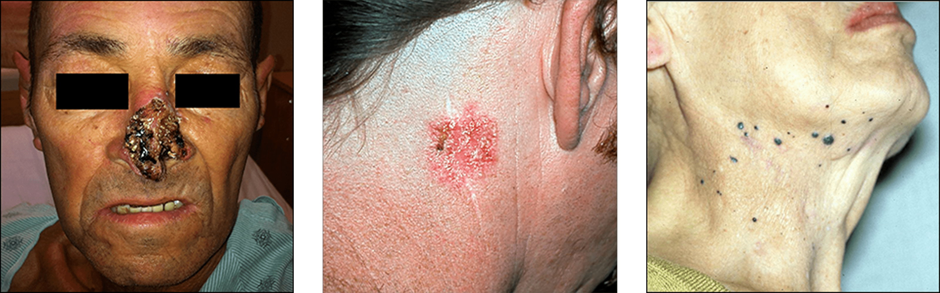 Skin Surgery (Mole and Cancer Removal) Skin Surgery (Mole and Cancer Removal)